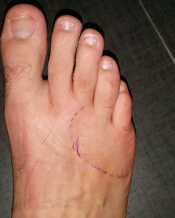 Spring break yields shark bite for McIntosh student