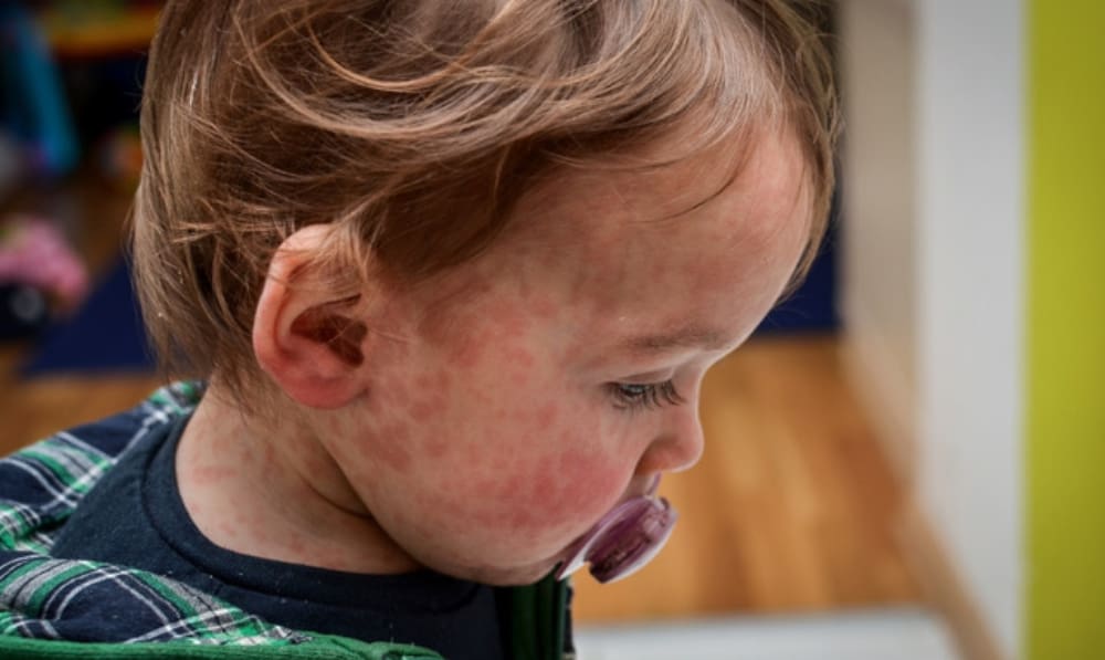 DPH Confirms Three New Measles Cases