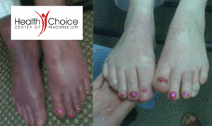 Peripheral Neuropathy treatment options at Healt...