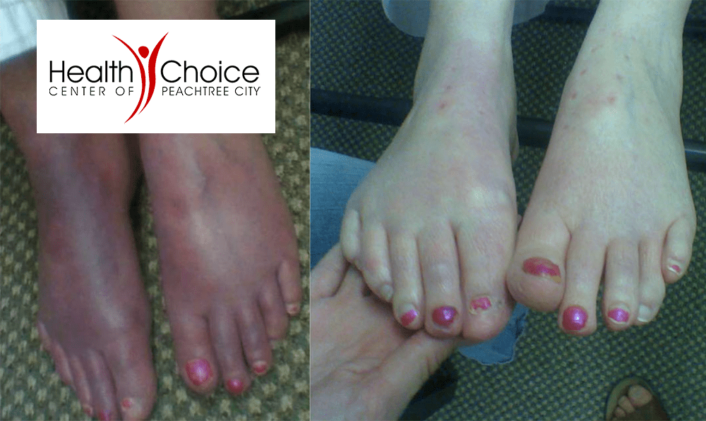 Peripheral Neuropathy treatment options at Healt...